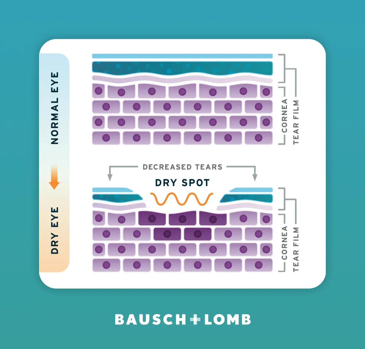 Bausch + Lomb Graphic